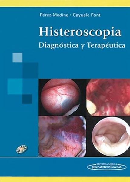 Histeroscopia "Diagnóstica y terapéutica"